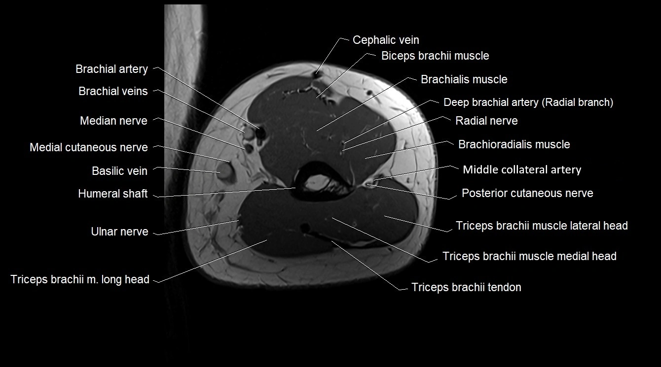 Upper arm( humerus) cross section anatomy MRI 3T axial image 47.webp